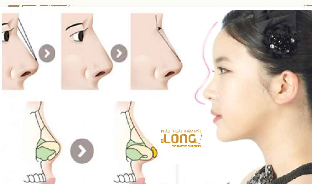 最新鼻整形技術(shù)重塑自信，煥發(fā)新生之美